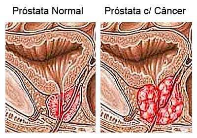 Câncer de Próstata é a segunda doença que mais atinge homens